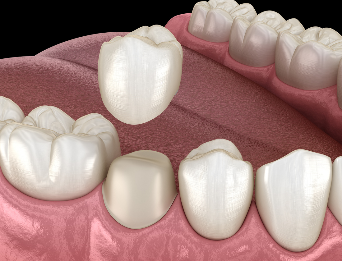 Preparated premolar tooth for dental crown placement. Medically accurate 3D illustration