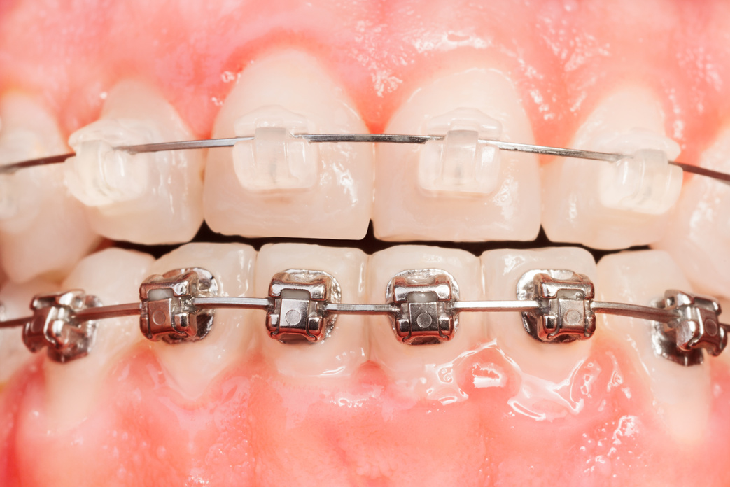 Ceramic and Metal Braces